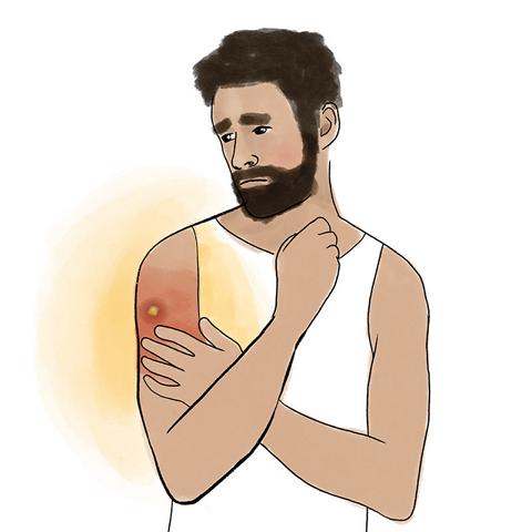 Entzündetes Gewebe